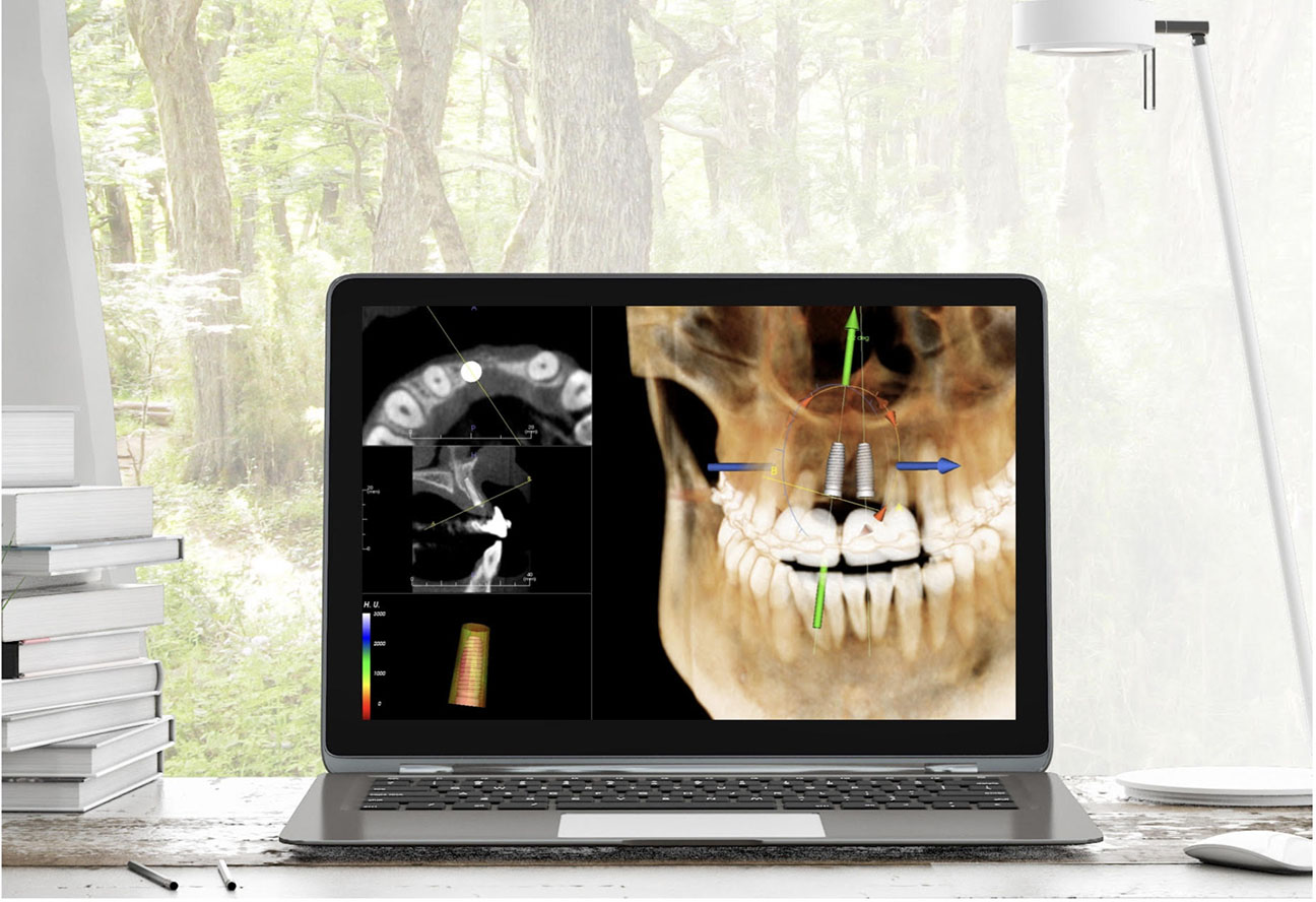 3-D image Show in Laptop for Accurate Treatment in San Rafael Dentistry