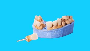 An Overview of Dental Bridges for Replacing Missing Teeth
