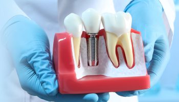Snap-in Dentures Vs. All-on-4 Dental Implants