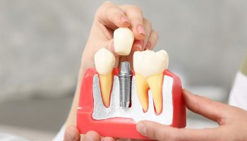 Dental Implants: What Are Abutments?