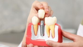 Dental Implant Placement: Digital Vs. Guided Implant Surgery