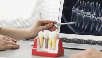How to Be Prepared for Dental Implant Surgery: A Complete Checklist